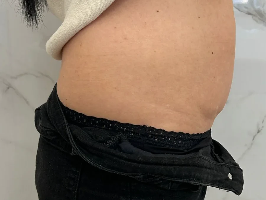 Criolipoliză abdomen lateral după o ședință — Contur Center Suceava