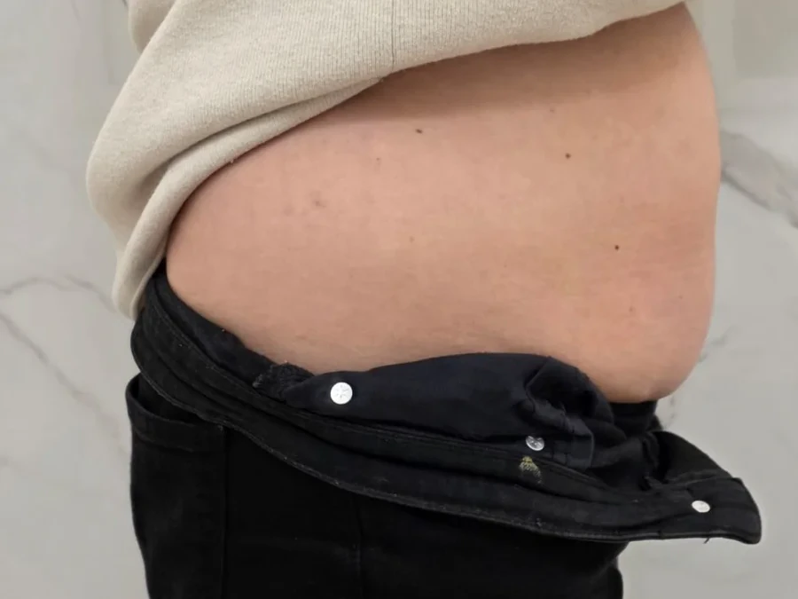 Criolipoliză abdomen lateral înainte — Contur Center Suceava