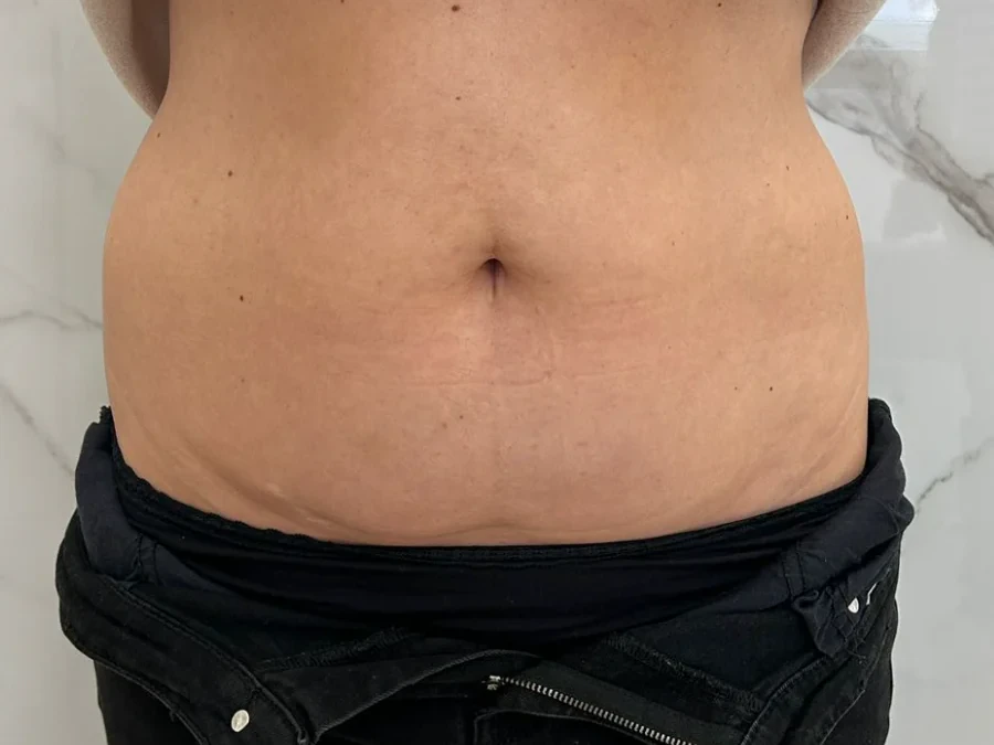 Criolipoliză după frontal — slăbire localizată Suceava