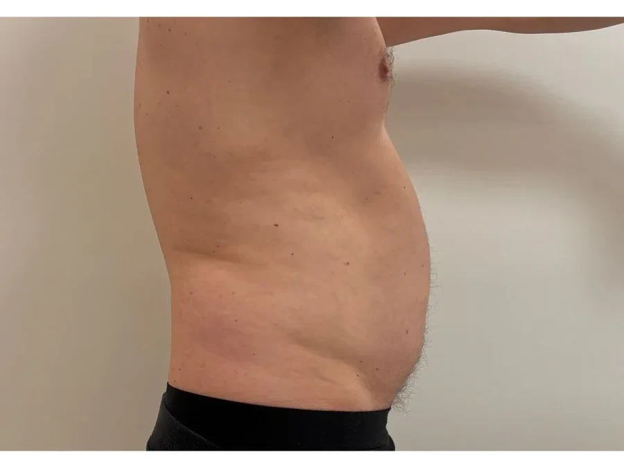 Criolipoliză abdomen lateral după o ședință — Contur Center Suceava