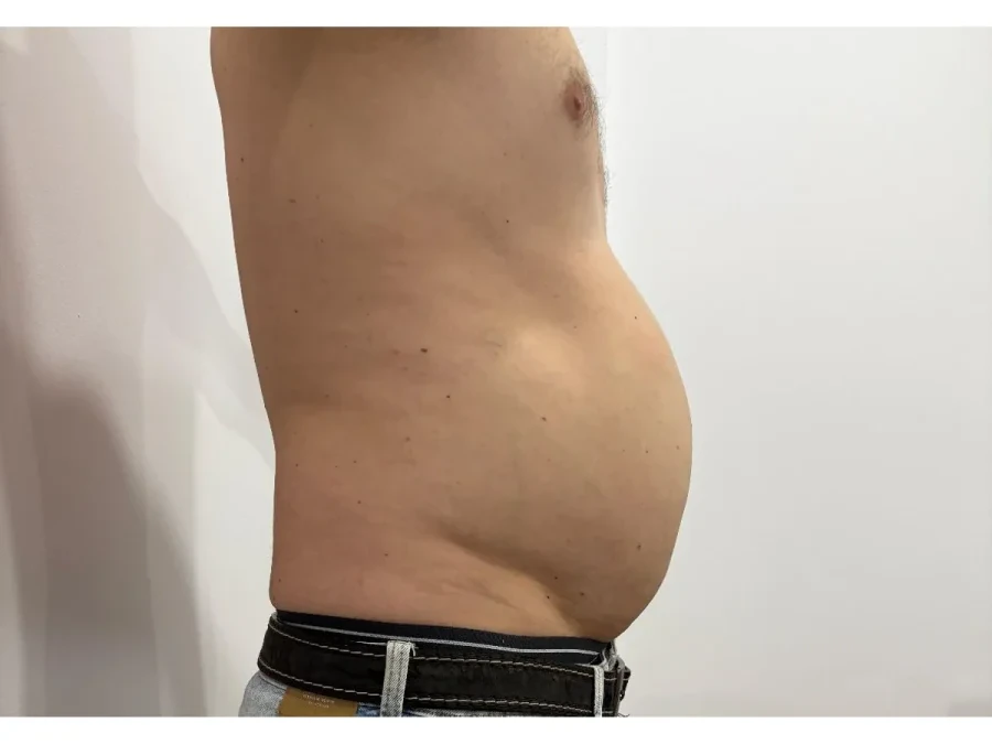 Criolipoliză abdomen lateral înainte — Contur Center Suceava