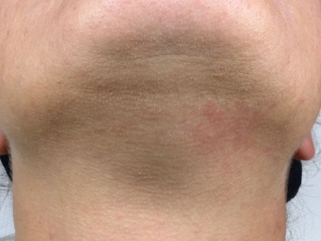 Epilare definitivă laser bărbie după tratament — piele netedă fără păr, Contur Center Suceava