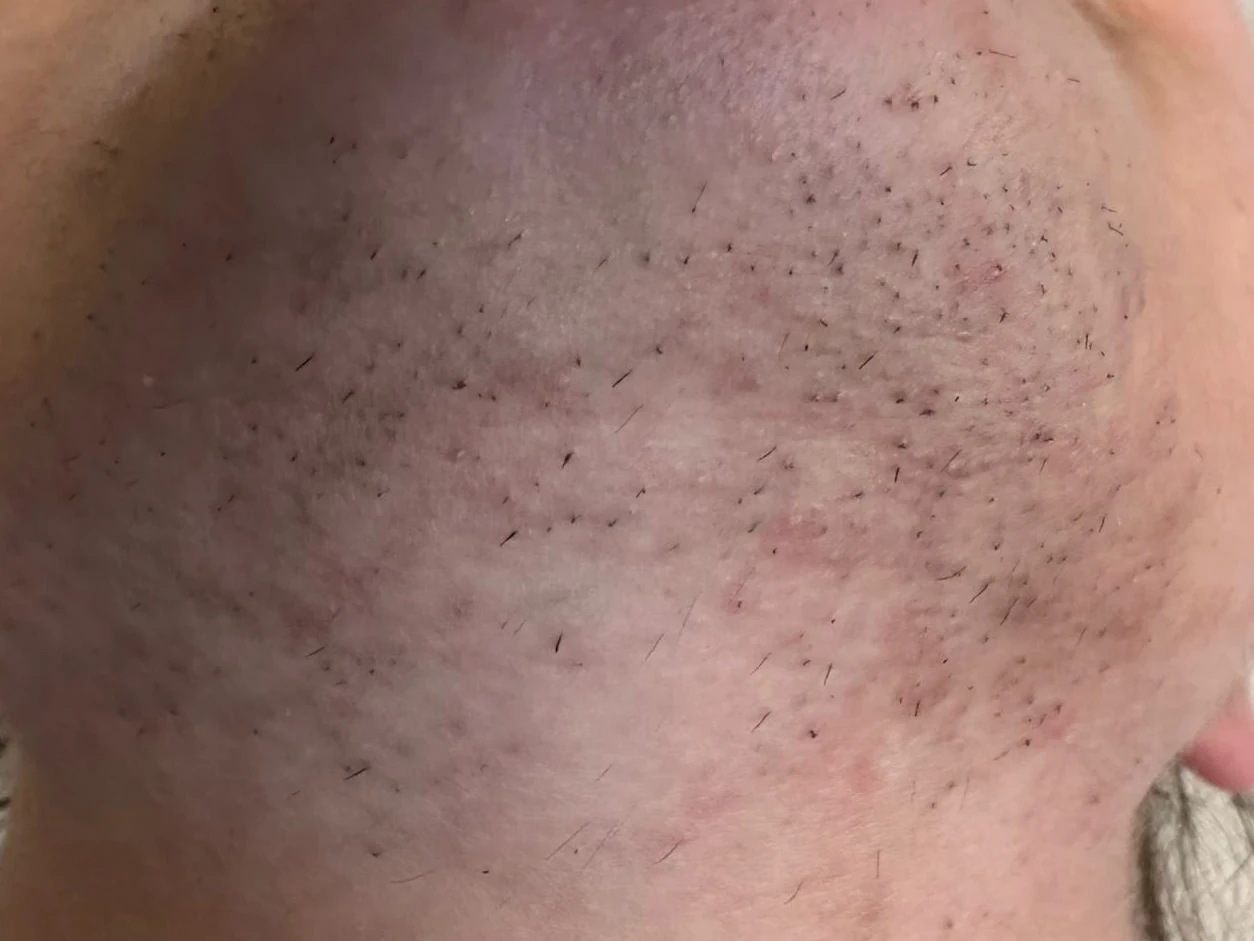 Epilare definitivă laser bărbie înainte de tratament — păr facial, laser diodă, Contur Center Suceava