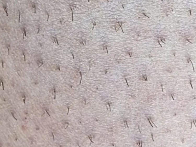 Epilare definitivă laser picioare înainte — Contur Center Suceava