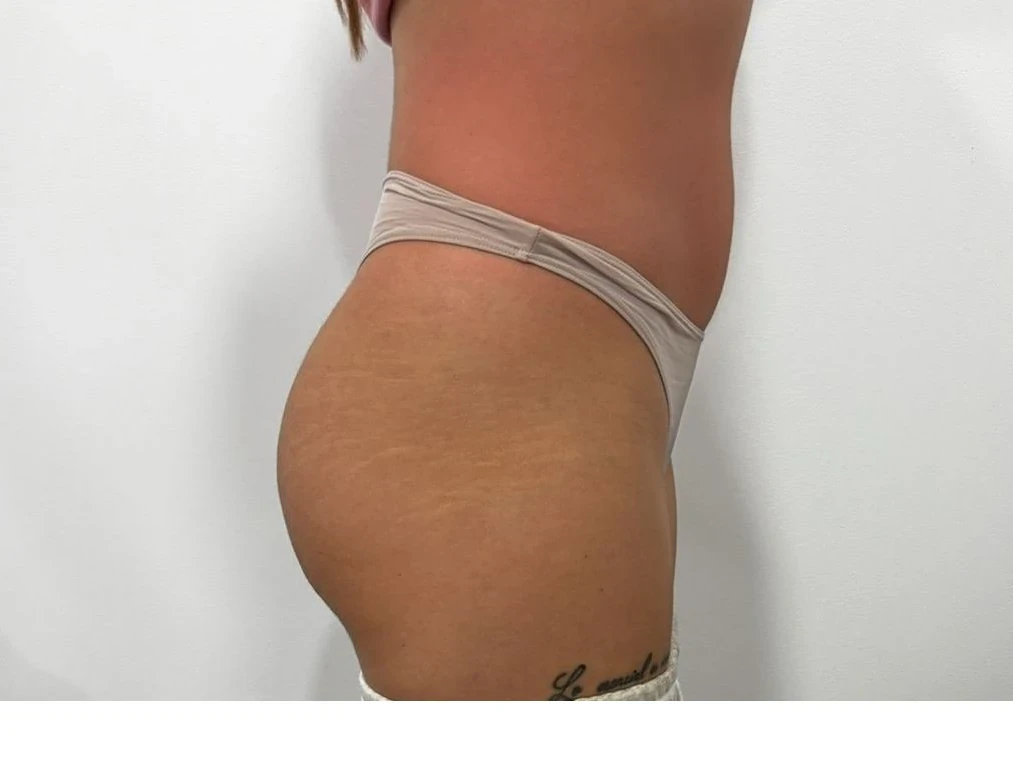 VelaShape II abdomen după 6 ședințe — Contur Center Suceava