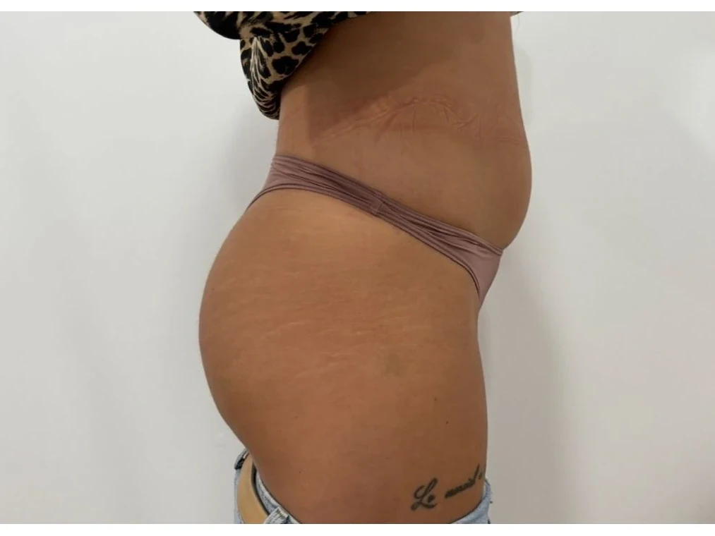 VelaShape II abdomen înainte — Contur Center Suceava