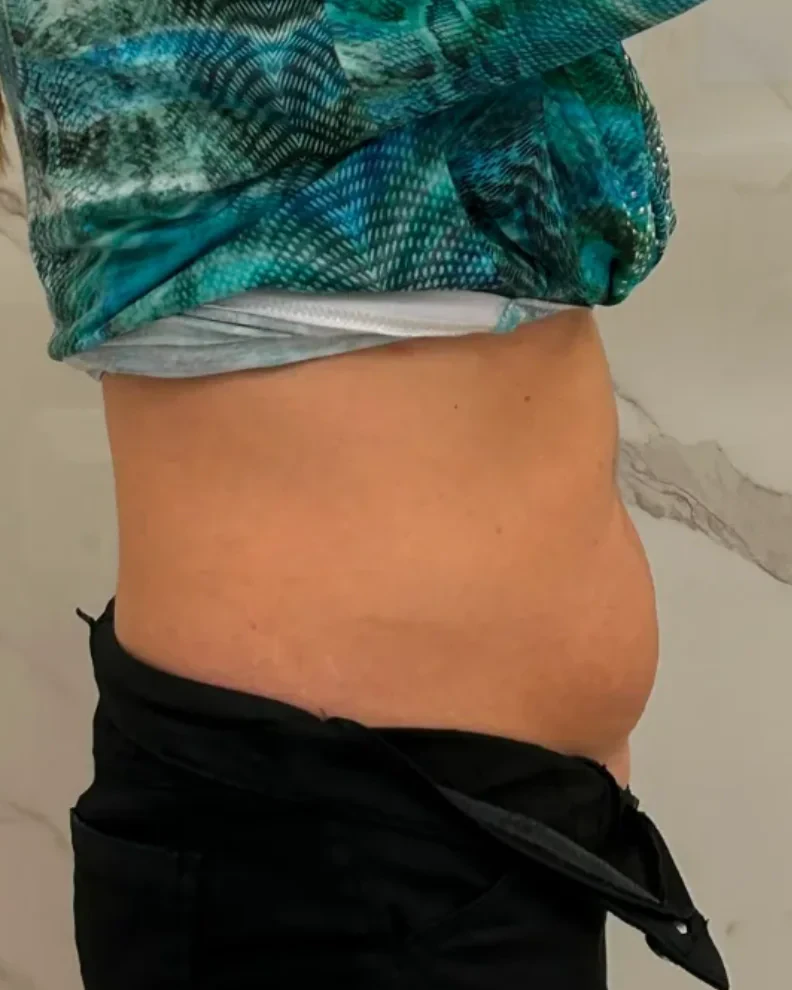 Criolipoliză și VelaShape II abdomen după protocolul complet — vedere laterală, talie remodelată, Contur Center Suceava