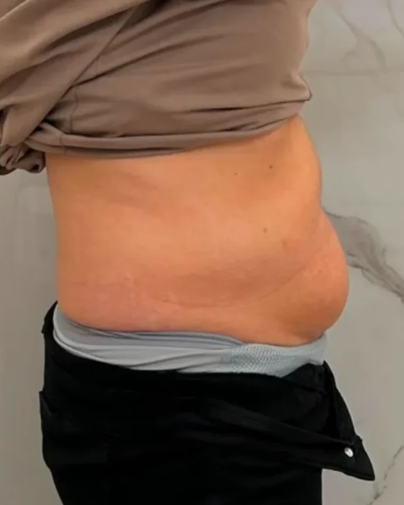 Criolipoliză și VelaShape II abdomen înainte — vedere laterală, Contur Center Suceava
