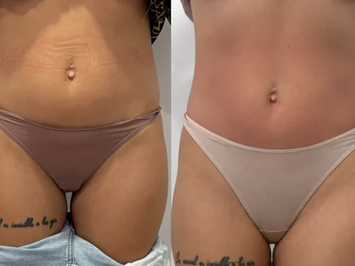 VelaShape II înainte și după 6 ședințe — remodelare corporală Contur Center Suceava