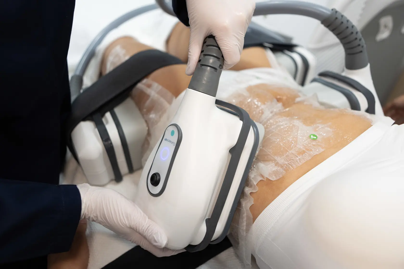 Aplicatoarele Cooltech Define pe abdomen și flancuri, cu membrana de protecție, în timpul unei ședințe de criolipoliză la Contur Center Suceava