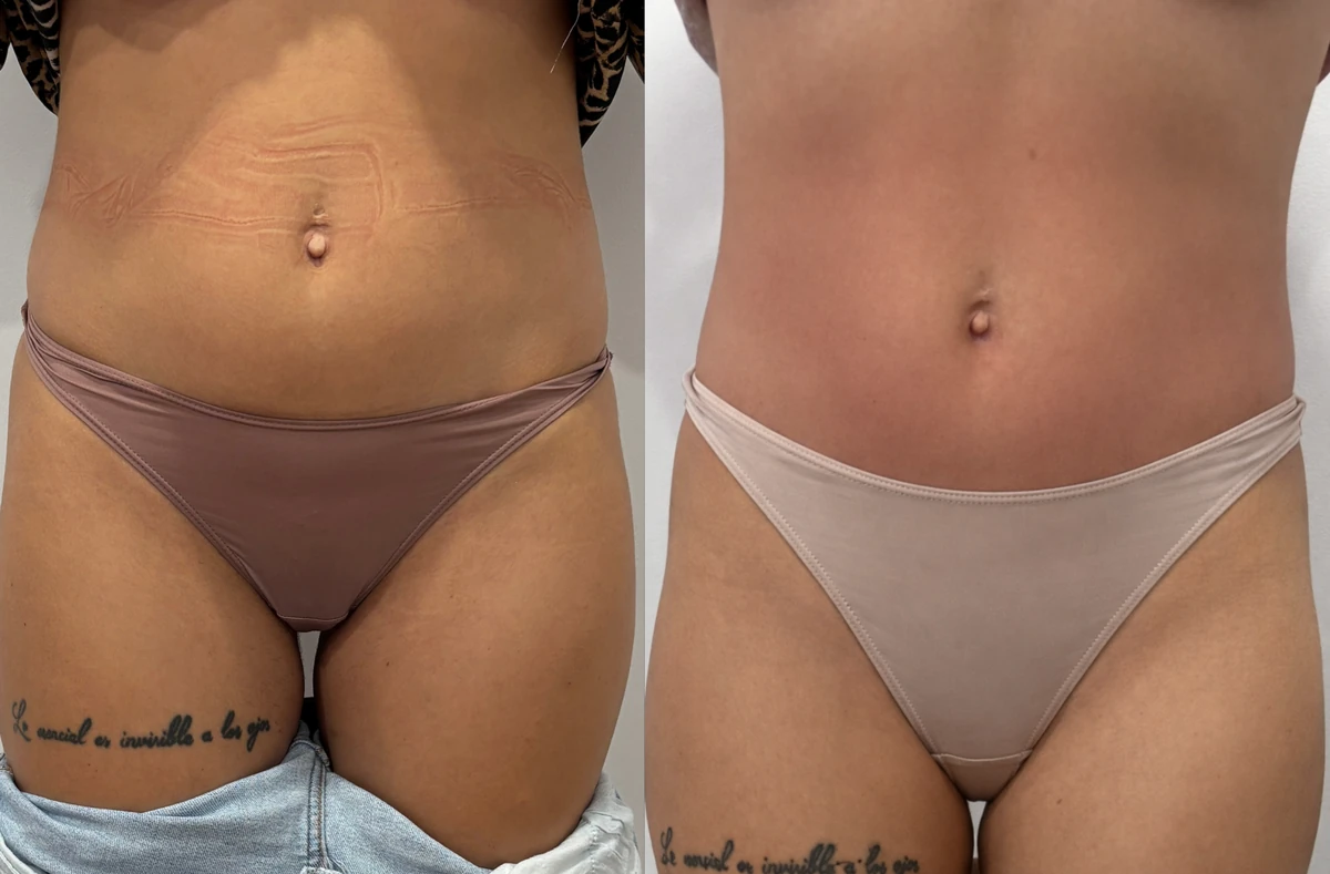 VelaShape II înainte și după 6 ședințe - eliminare celulită și piele fermă - remodelare corporală Contur Center Suceava