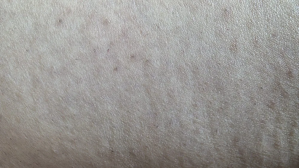 Epilare definitivă laser picioare după tratament - piele fină fără păr - rezultat vizibil Contur Center Suceava