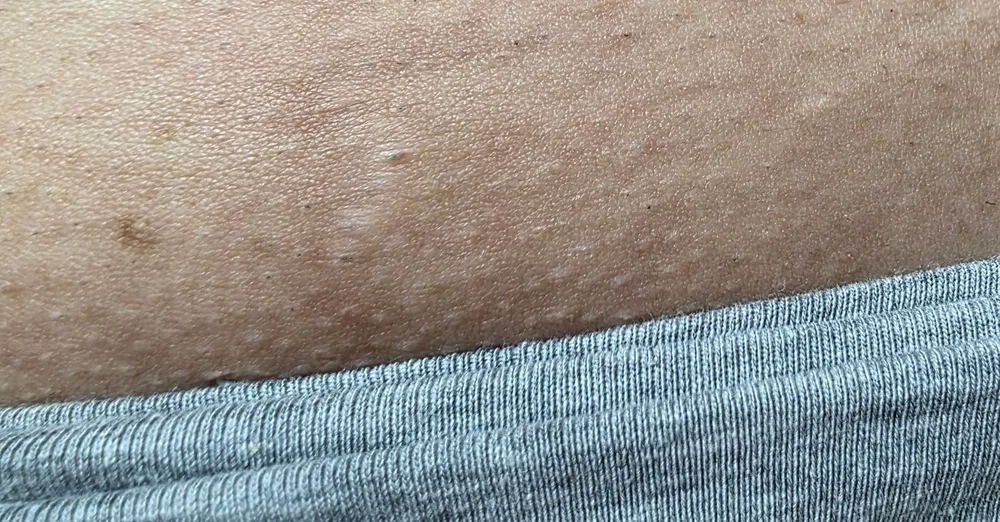 Epilare definitivă laser zona inghinală după tratament - piele netedă fără păr - rezultat permanent Contur Center Suceava