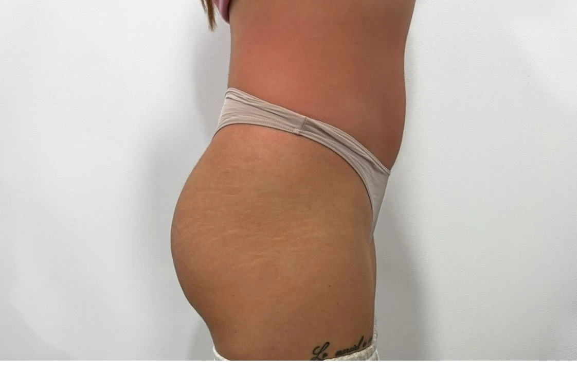 VelaShape II abdomen după 6 ședințe - piele fermă fără celulită - rezultat tratament anticelulitic Contur Center Suceava