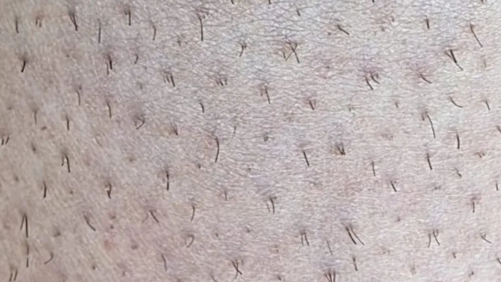 Epilare definitivă laser picioare înainte de tratament - epilare permanentă laser diodă - Contur Center Suceava