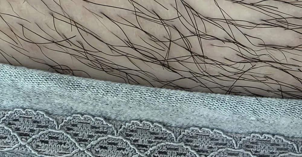 Epilare definitivă laser zona inghinală înainte - laser diodă 808nm - salon epilare permanentă Contur Center Suceava