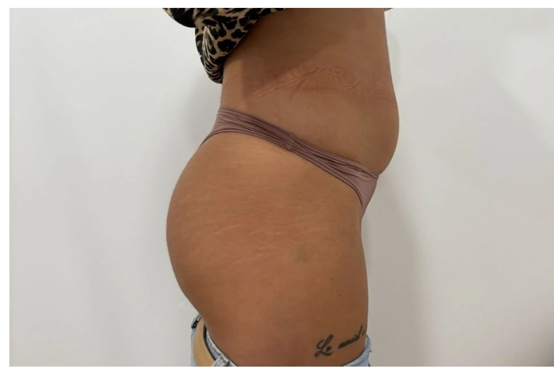 VelaShape II abdomen înainte de tratament - celulită vedere laterală - salon anticelulitic Contur Center Suceava