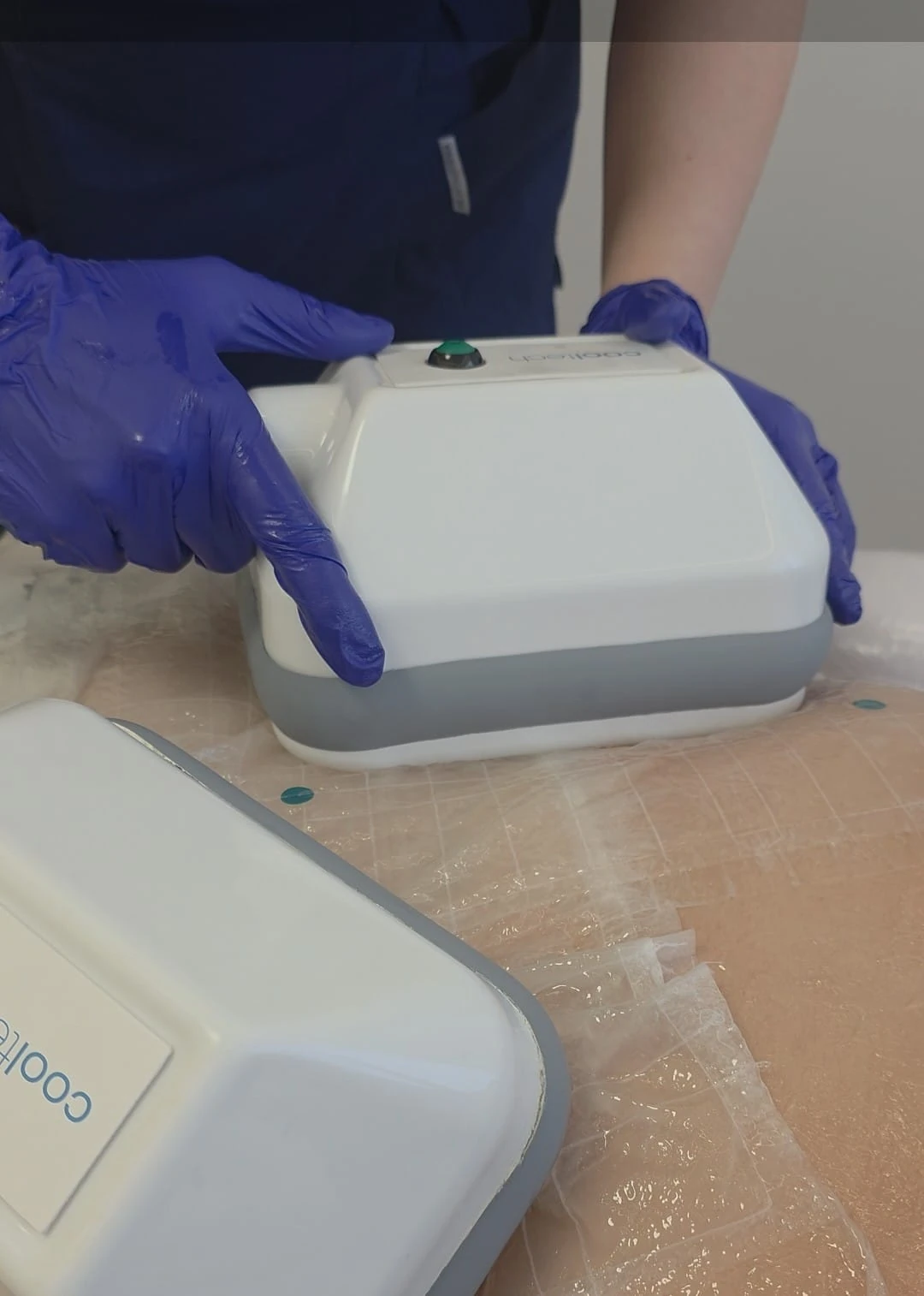 Criolipoliză - slăbire localizată fără chirurgie la Contur Center Suceava