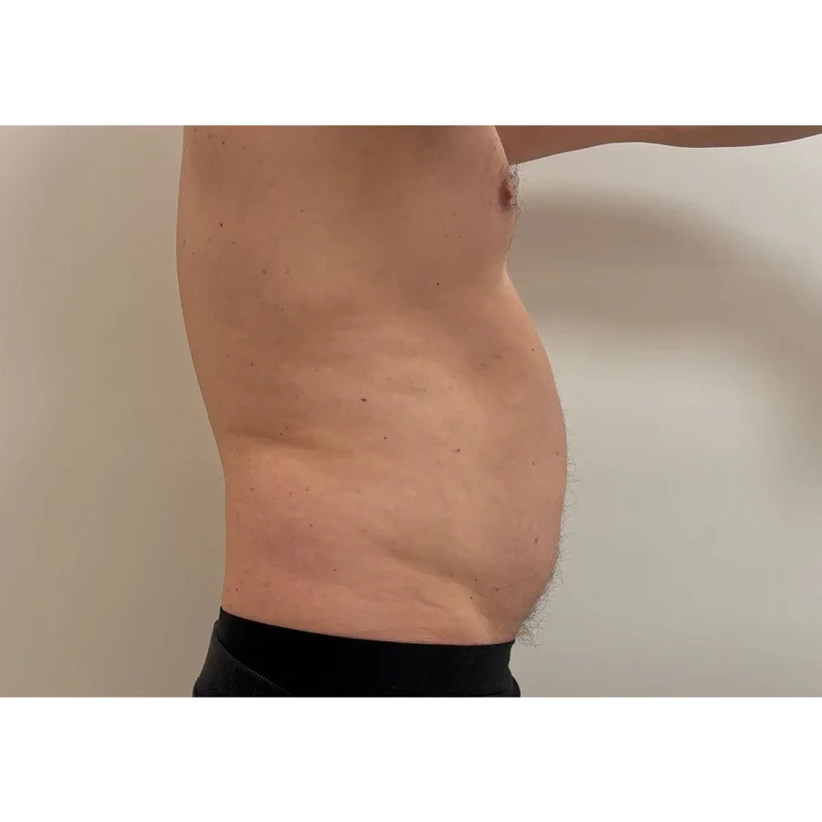 Criolipoliză abdomen rezultat lateral după 1 ședință - slăbire localizată vizibilă - remodelare corporală Contur Center Suceava