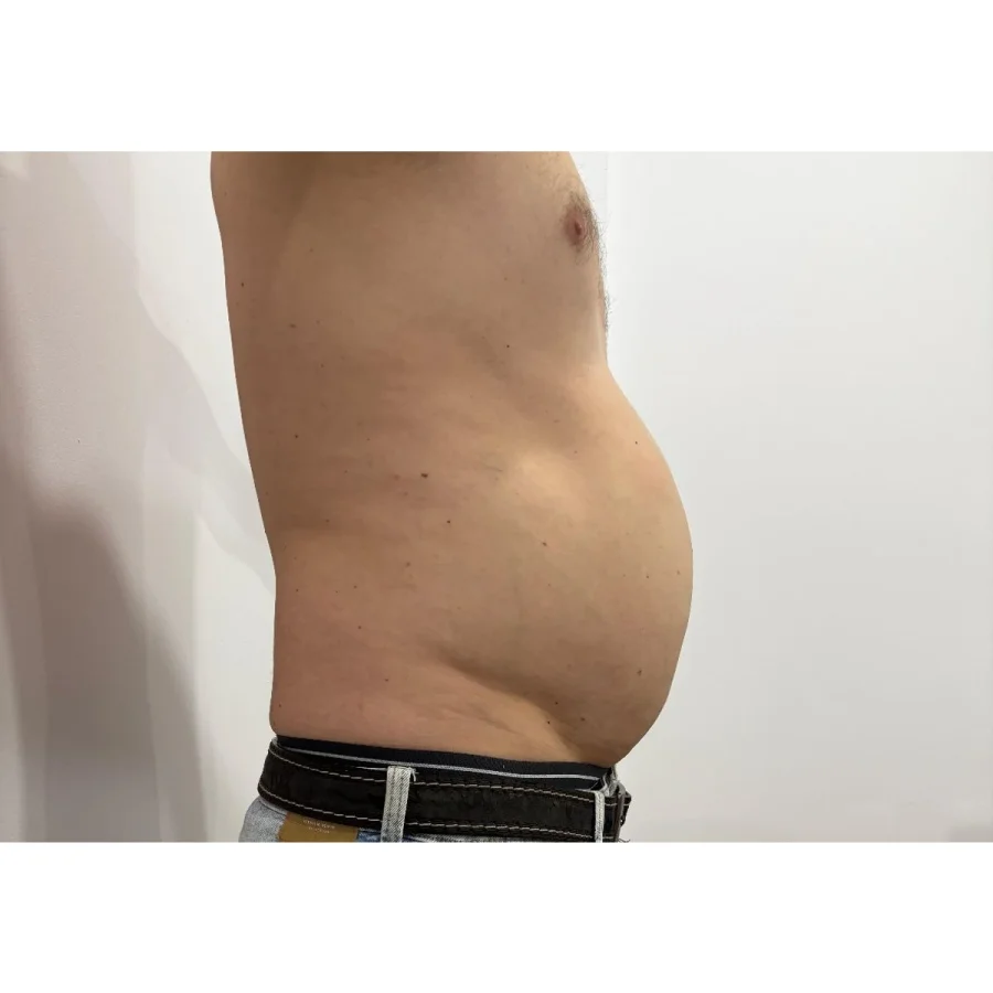 Criolipoliză abdomen vedere laterală înainte - eliminare grăsime localizată fără liposucție - Contur Center Suceava
