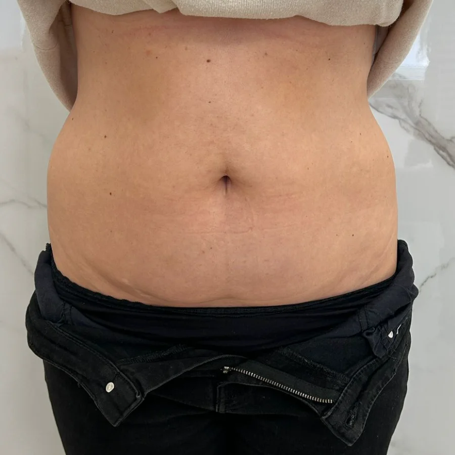 Criolipoliză după — abdomen frontal, Contur Center Suceava