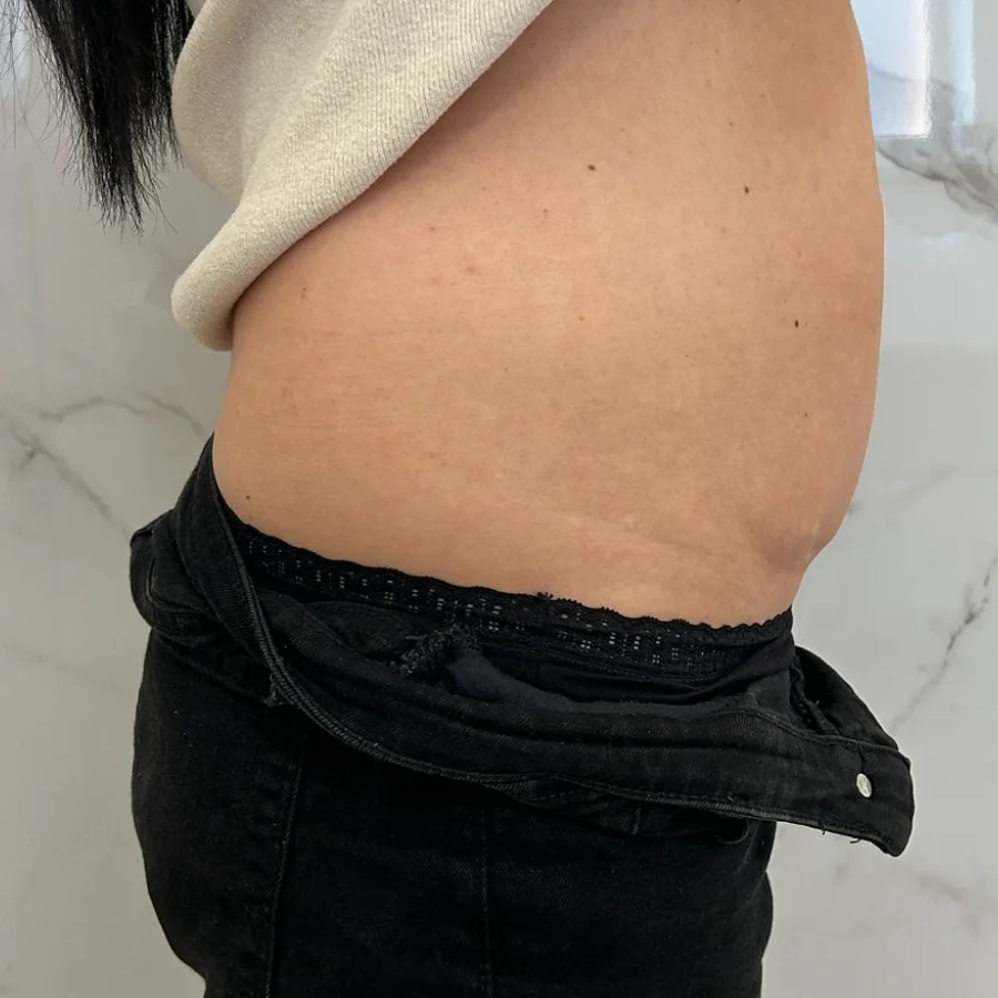 Criolipoliză după — abdomen lateral, Contur Center Suceava