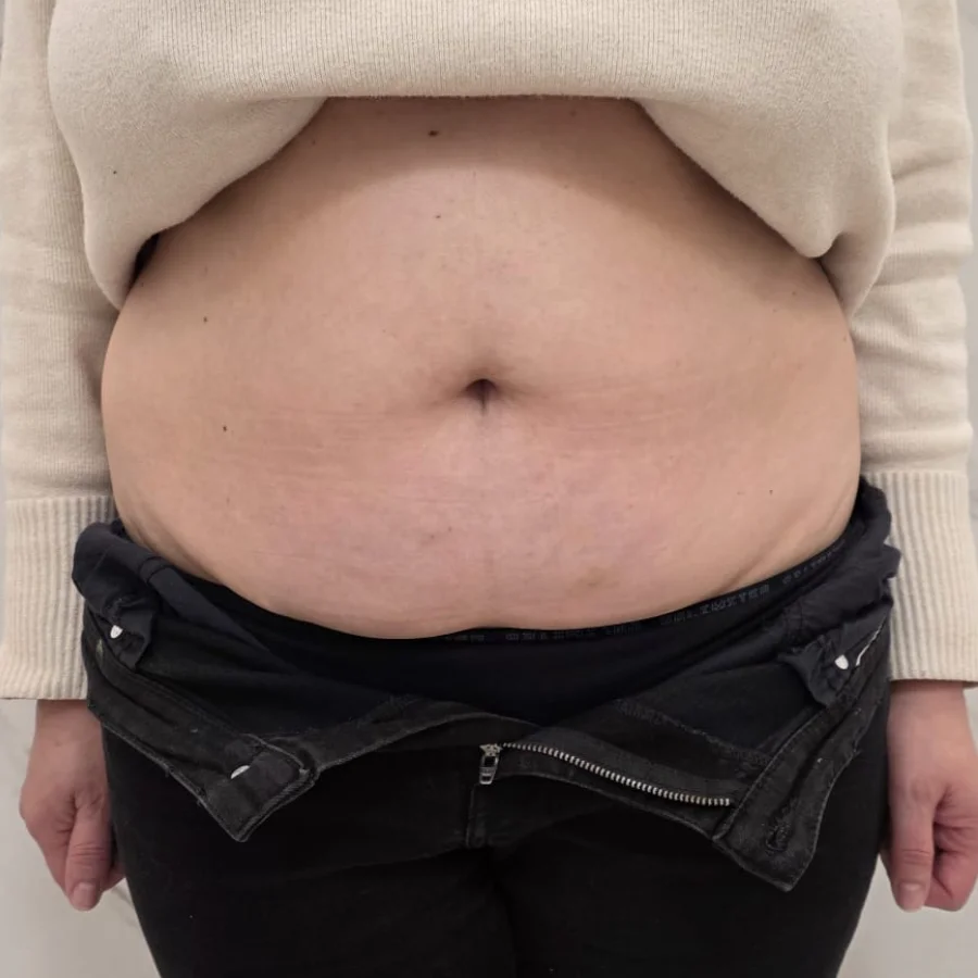 Criolipoliză înainte — abdomen frontal, Contur Center Suceava