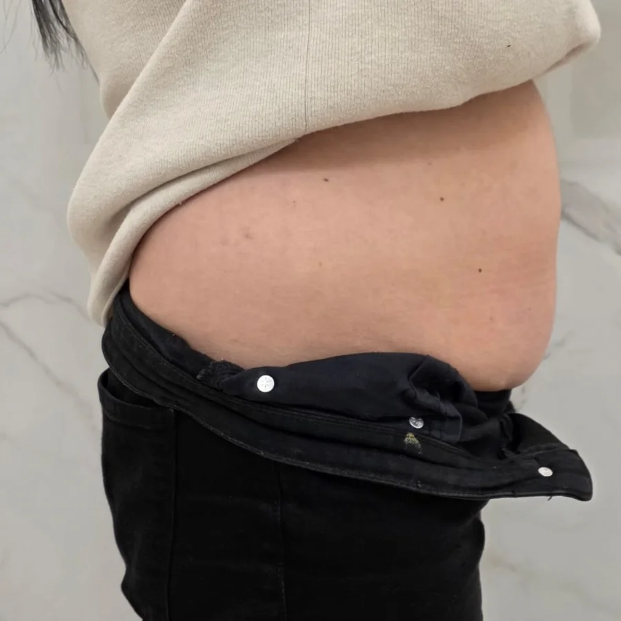 Criolipoliză înainte — abdomen lateral, Contur Center Suceava