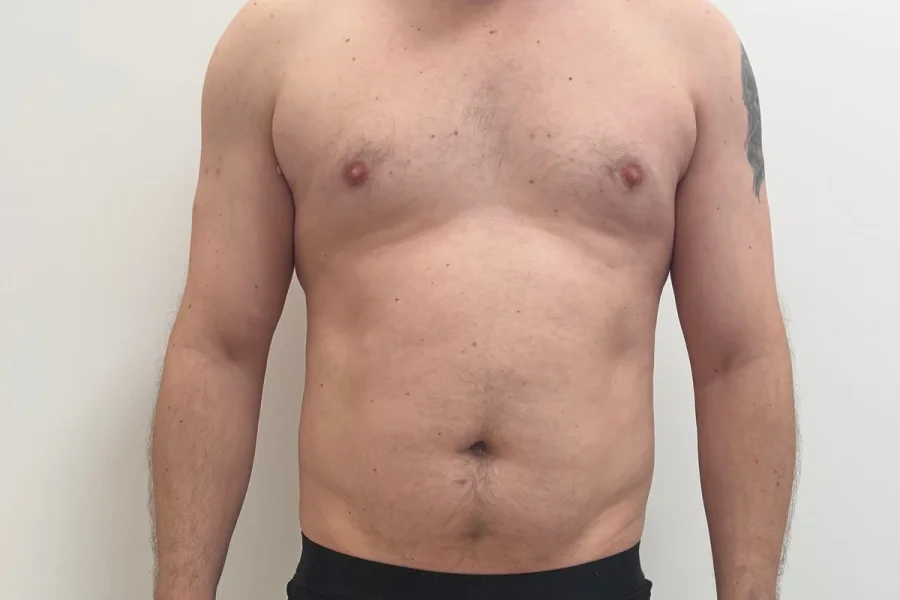 Criolipoliză abdomen rezultat după 1 ședință - reducere grăsime vizibilă frontal - remodelare corporală Contur Center Suceava