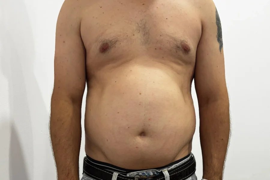 Criolipoliză abdomen înainte - slăbire localizată fără chirurgie vedere frontală - Contur Center Suceava